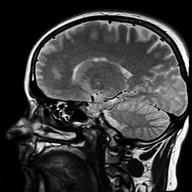 Imagen del cerebro a través de resonancia magnetica funcional